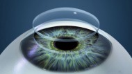 Implantan por primera vez en España una córnea artificial Implantan por primera vez en España una córnea artificial